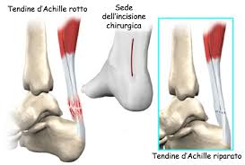 Anche se il tendine di achille può resistere a grandi sollecitazioni quando si corre o si salta, può infiammarsi, un problema questo associato con un uso eccessivo e con la. Lesione Tendine Di Achille Dalla Diagnosi All Intervento Chirurgico Dr Stefano Viglione
