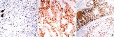 Expression Of Hbme 1 In Thyroid Carcinomas A Undifferentiated Download Scientific Diagram