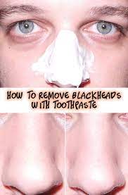how to remove blackheads with toothpaste mitesser entfernen mitesser toupierte haare