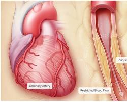 Image of Plaque buildup in coronary arteries