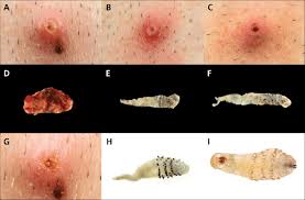 Human botfly infestation is not usually harmful, but incomplete extraction may trigger a foreign body reaction or may lead to secondary bacterial infection.3 attempting to squeeze out the botfly is not. Travel Acquired Myiasis Caused By Dermatobia Hominis In A 33 Year Old Download Scientific Diagram