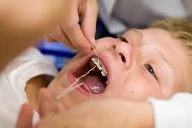 Treatment time is slower and it is also more expensive. What To Expect Once You Have Braces Absolute Dental