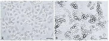 Pancreatic cancer — overview covers symptoms, risk factors, prevention, diagnosis, surgery, chemotherapy and other treatment for cancer of the pancreas. Sortilin May Hold The Key To Combat Pancreatic Cancer More Effectively Eurekalert Science News