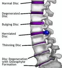Pin On L Spine