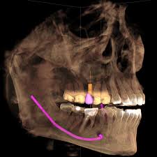 Galileos Comfortplus Dental Dental Health Care Implant Dentistry