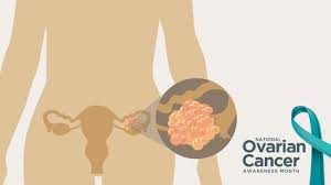 Rarely, some types of ovarian cysts can develop into ovarian cancer. National Ovarian Cancer Awareness Month Right At Home In Home Care For Seniors
