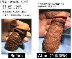 チンポ 増大