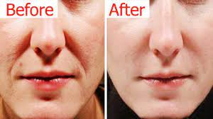 To perform this exercise, close your eyes and slide your thumbs away from your eyes toward your temples. How To Get Rid Of Laugh Lines Naturally Remove Wrinkles Around The Mouth Https Youtu Be Ud2xqiscrt0 Smile Wrinkles Mouth Wrinkles Get Rid Of Laugh Lines
