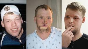 The first face transplant surgery was performed ten years ago this month. Twin Tragedies Give Survivor A New Face Ctv News
