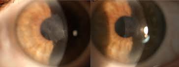 Crstg | Europe Edition | Corneal Haze After Prk Enhancement Of Prior Lasik
