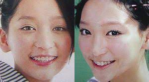 歯列矯正 してる してた有名人画像 1 2 歯列矯正 費用 保険 歯列矯正 有名人 モデル 写真