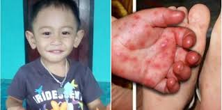 Seorang ibu berkongsi cerita tentang jangkitan penyakit tangan kaki dan mulut pada bayi. Virus Hfmd Turut Jangkiti Orang Dewasa 10 Rawatan Ini Boleh Bantu Theasianparent Malaysia