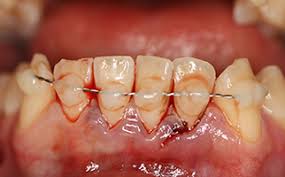 Image result for Tooth Luxation