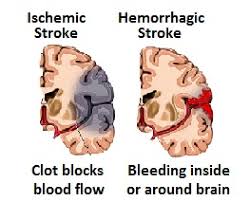 The brain is very complex. Stroke Brain Injury And Its Causes And Rehabilitation