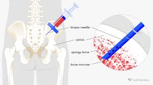Image result for Bone Marrow Exam