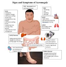Image result for Acromegaly