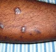 Lichen Planus: Symptoms, Diagnosis, Treatment, and Risks