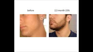 Before & after using minoxidil. Stimulate Beard Growth With Minoxidil Before After Youtube