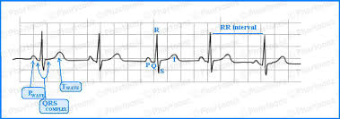 How To Read Ecg Basic Common Charts Phartoonz