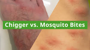 Image result for mosquito bite