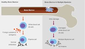 Multiple Myeloma Myeloma Multiple Myeloma Cancer Help