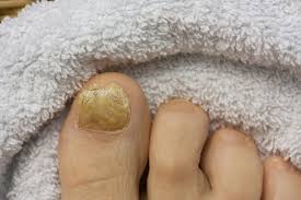 How long does it take for a toe nail to grow back? If I Get My Toenail Removed Will The Fungal Nail Grow Back Prairie Path Foot Ankle Clinic