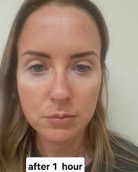 Hi there 👋 Here is Lucy. She was my model for the event and kindly sent  these photos to document how her skin reacted after her Microneedling. As  you can see, she