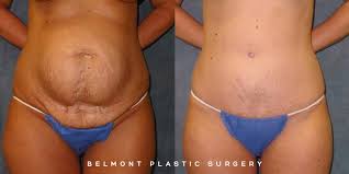 Maybe you would like to learn more about one of these? Tummy Tuck Washington Dc Dc Abdominoplasty Chevy Chase Belmont Plastic Surgery