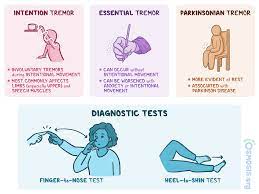 Ets event of fall 2013; Intention Tremor What Is It Causes Diagnosis Treatment And More Osmosis