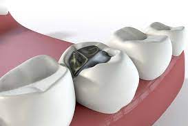 Once a restoration is engaged, care must be taken into account to uphold its integrity. When Can You Eat And Drink After A Tooth Filling Studio Dentaire