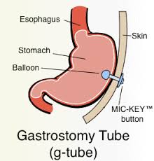 Changing A G Tube Gastric Feeding Tube Gastrostomy Tube Feeding Tube Awareness Feeding Tube