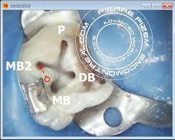 (1) identification of the principle canals. Root Canal Procedure Versus A Rare Anatomical Variation Endomontreal