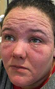 I don't want to waffle on and on about the ins and outs of hair dye allergy in this post (although if you're interested in that, i waffled on and on about it here!) instead, i want to. Mum Scarred By Horrific Allergic Reaction To Hair Dye Which Was Mistaken For Herpes