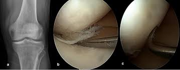 The purpose of this trial is to evaluate the safety and effectiveness of the biphasic cartilage repair implant (bicri) compared to marrow stimulation in the treatment of chondral and osteochondral lesions located on the medial femoral condyle, lateral femoral condyle, or trochlea of the knee. Can Ellipsoid Sign Be One Of The Earliest Findings Of The Medial Femoral Condyle Chondromalacia Of Knee Antero Posterior X Ray Springerlink