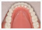 Apr 27, 2021 · how much do permanent retainers cost? Permanent Retainer 6 Pros And Cons Braces Or Invisalign