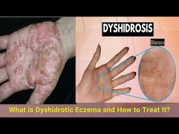 Image result for dyshidrosis
