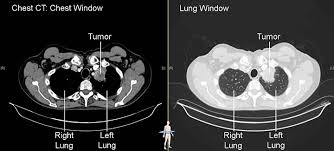 Your doctor may order other tests to. Imaging Tests Lungevity Foundation