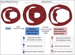 From wikipedia, the free encyclopedia in cardiology, ventricular remodeling (or cardiac remodeling) refers to changes in the size, shape, structure, and function of the heart. Signaling Pathways Of Cardiac Remodeling Related To Angiotensin Ii Intechopen