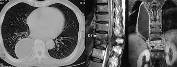 Images from teaching files of afshin karimi, md, phd, jd, assistant clinical professor of radiology, university of california medical center, san diego. Thoracic Contrast Enhanced Computed Tomography Showing Loculated Download Scientific Diagram