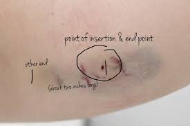 It is very effective (greater than 99%) at preventing pregnancy. Aubrey Kinch My New Implant Birth Control