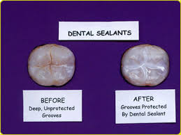 After sealant has been applied it keeps those bits of food out and stops bacteria and acid from settling on your teeth—just like a raincoat keeps you clean and how are sealants applied? Dental Sealants Protecting Your Teeth