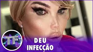 Jessica alves has just '20 percent' of her stomach left after undergoing gastric sleeve surgery two weeks ago in turkey. Jessica Alves Ex Ken Humano Faz Cirugia Para Corrigir Buraco No Rosto Youtube