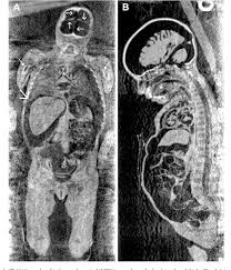 Rosalia lombardo was only two years old when she died from pneumonia in 1920. Figure 3 From Multidetector Ct Investigation Of The Mummy Of Rosalia Lombardo 1918 1920 Semantic Scholar