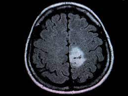 Hirntumor Mit Strahlen Gegen Die Geschwulste Im Kopf Gesundheit