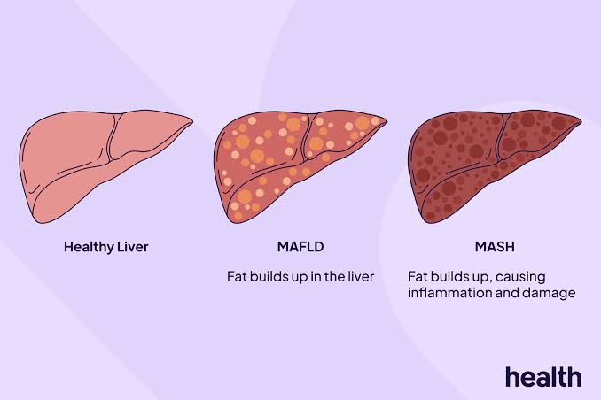 MAFLD vs. MASH: What's the Difference?