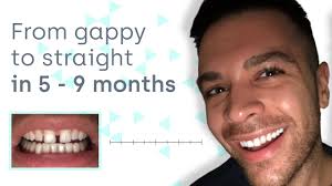 That being said, there really isn't a lot of evidence to back up the whitening effects of coconut oil on teeth. How To Close Teeth Gaps Safely And Invisibly At Home Youtube