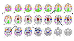 Although bipolar disorder is a lifelong condition, you can manage your mood swings and other symptoms by following a treatment plan. Brain Scan Data Discovery Could Revolutionize Treatment Of Bipolar Disorder Depression Unm Newsroom