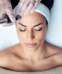 Microneedling with SkinPen at Ascot Dental Suite