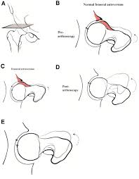 Image result for Femoral Retroversion