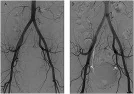 Epithelial tumors account for roughly 90% of ovarian cancers and are most common among postmenopausal while ovarian cancer was once referred to as a silent killer characterized by a lack of signs and. Frontiers Endometriotic Mass After Hysterectomy In A 61 Year Old Post Menopausal Woman A Case Report And Update Surgery